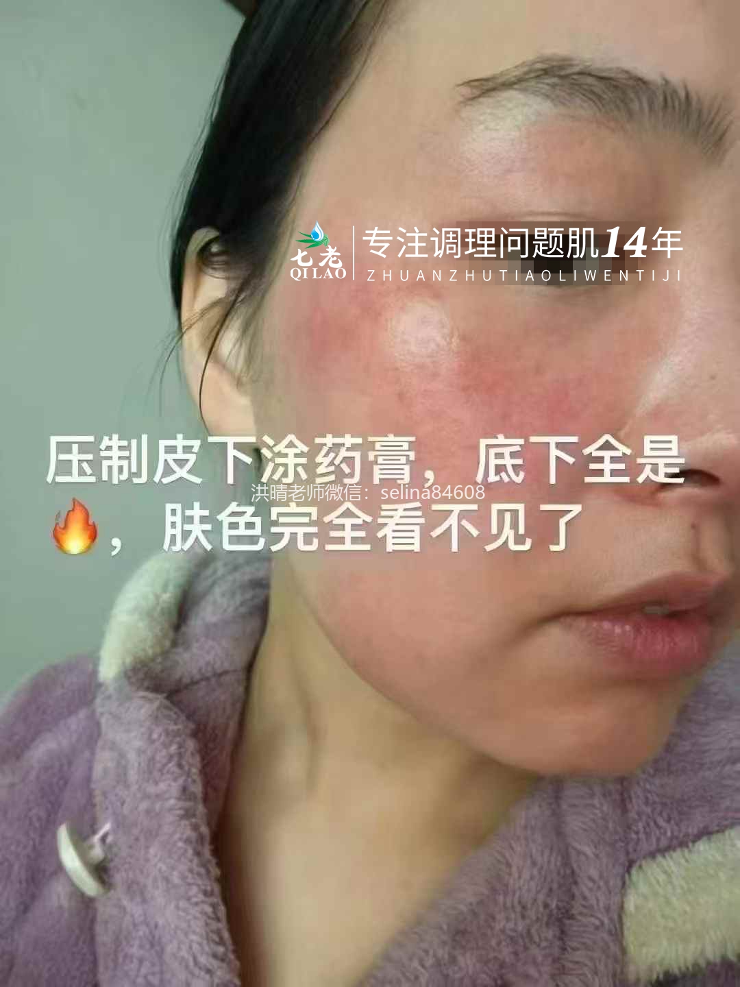 七老激素脸修护案例