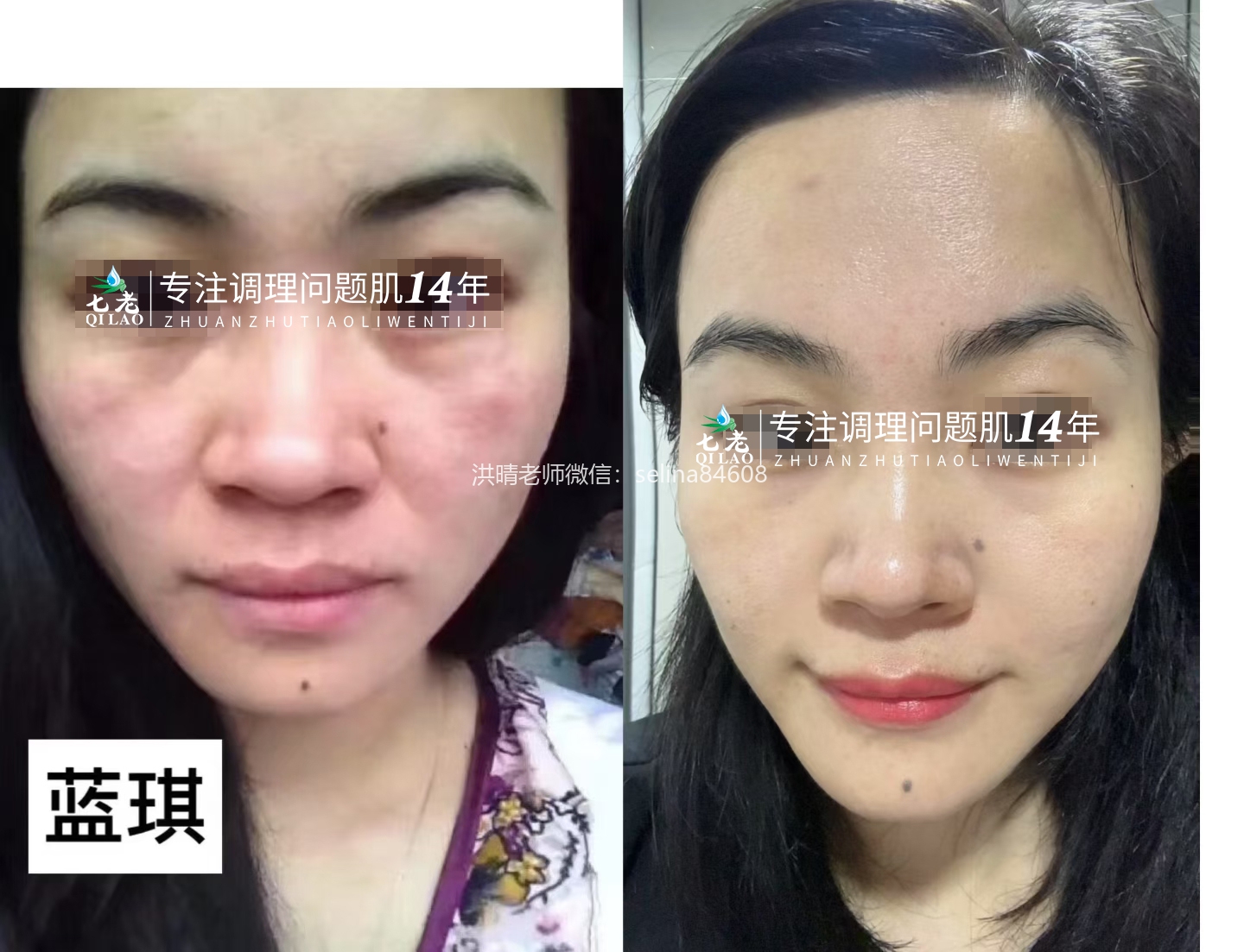 七老反复过敏修复案例