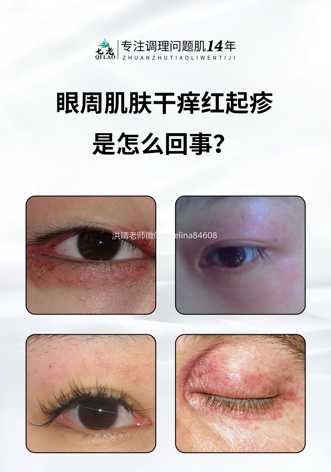 眼周反复红肿痒干痒疹子过敏怎么办？