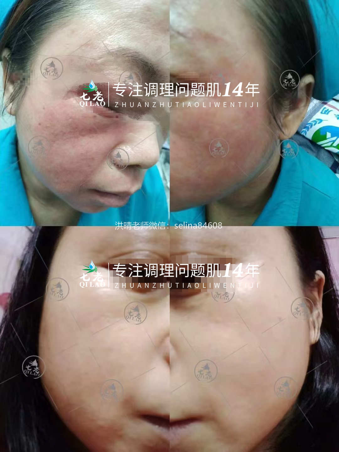 七老激素脸修复案例