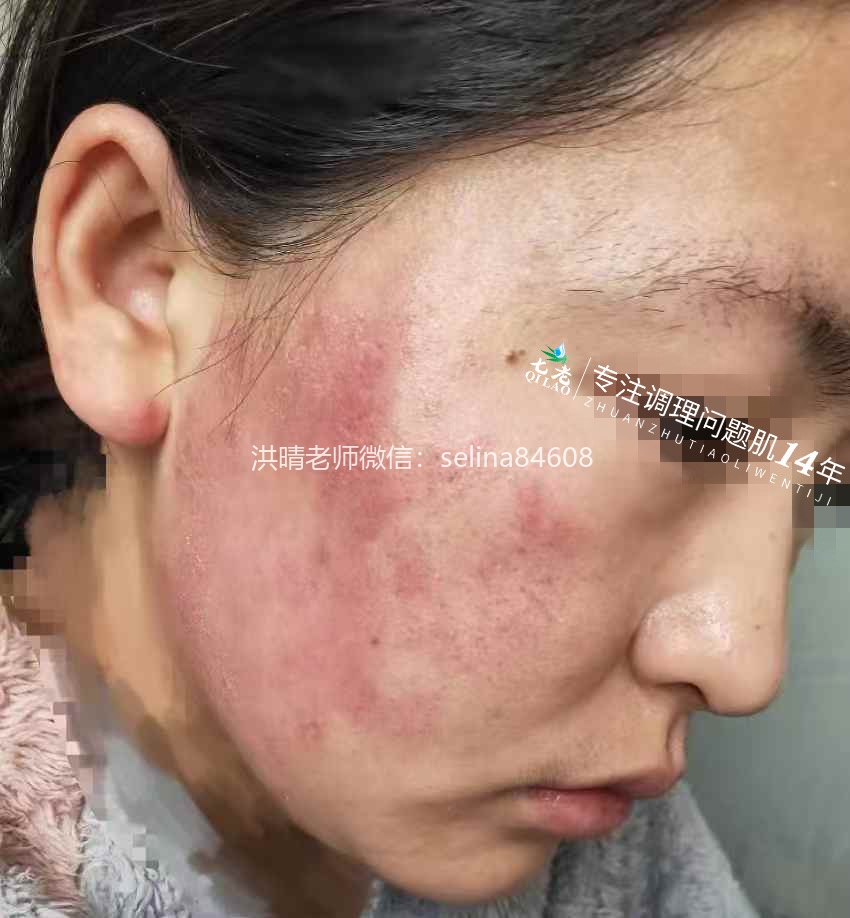 七老激素脸玫瑰脸修护案例