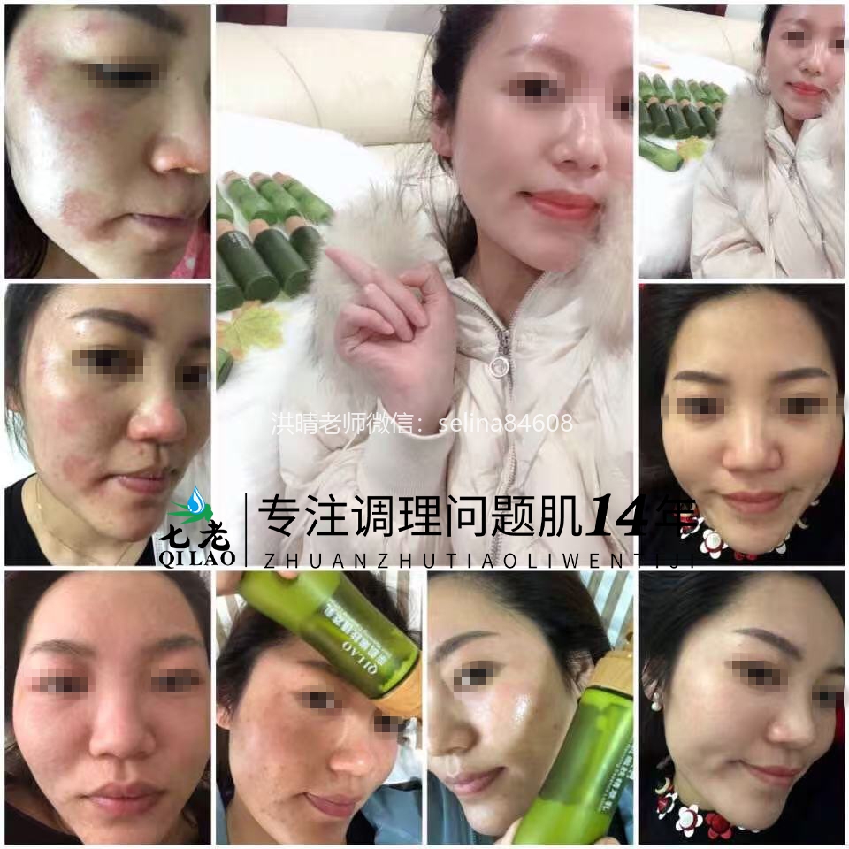 七老激素脸修护案例