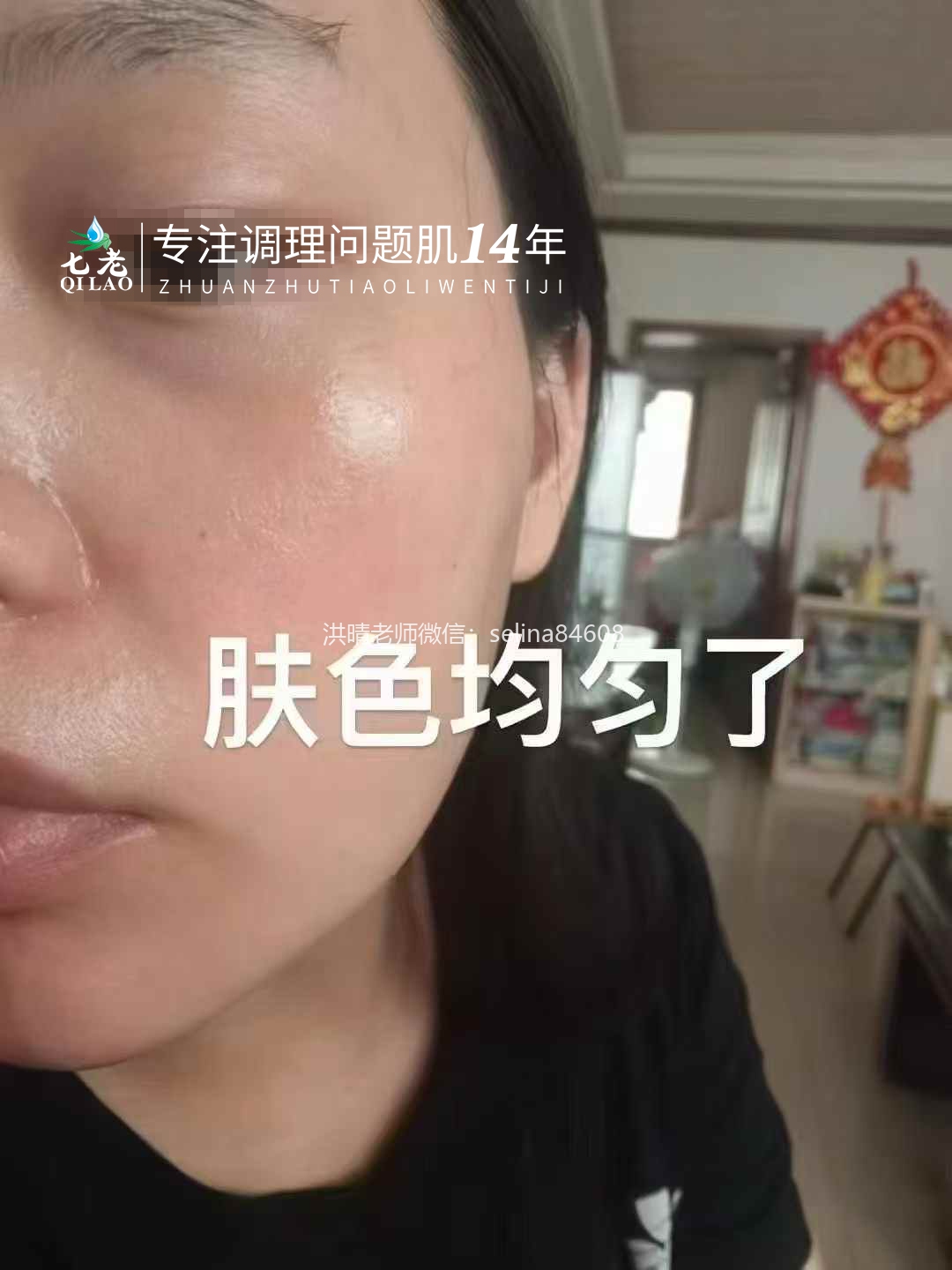 七老激素脸修护案例