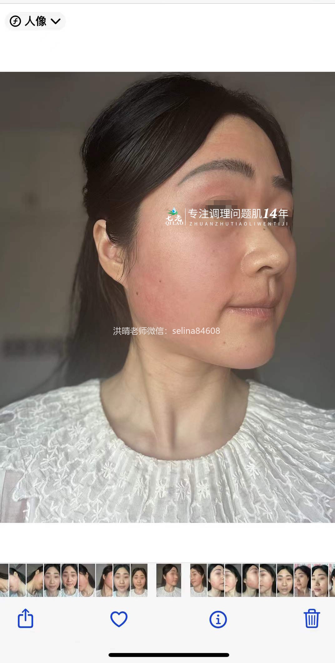 七老反复过敏修护案例