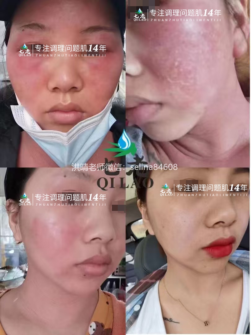 七老严重激素脸修护案例