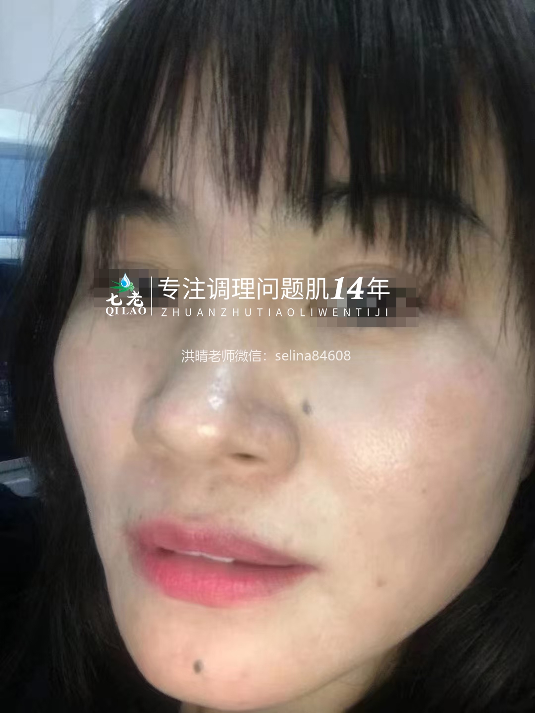 七老反复过敏修复案例