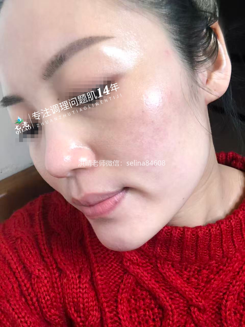 七老激素脸修护案例