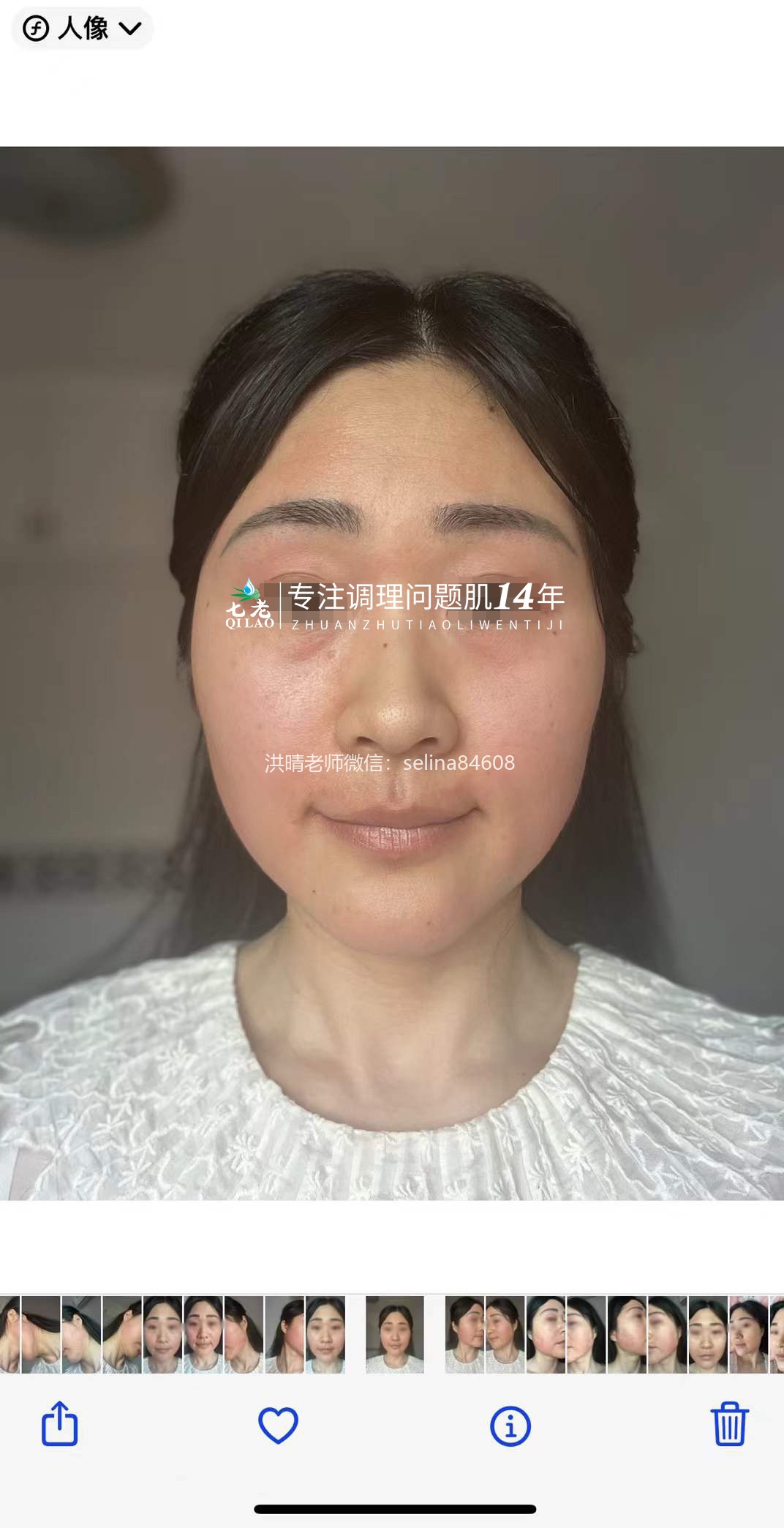 七老反复过敏修护案例