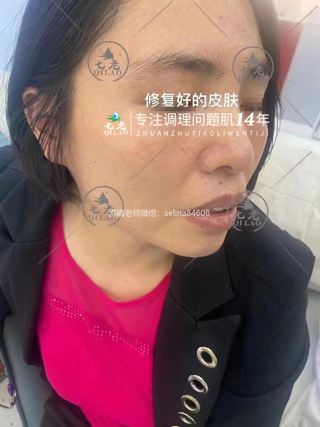 七老日光性皮炎修护案例