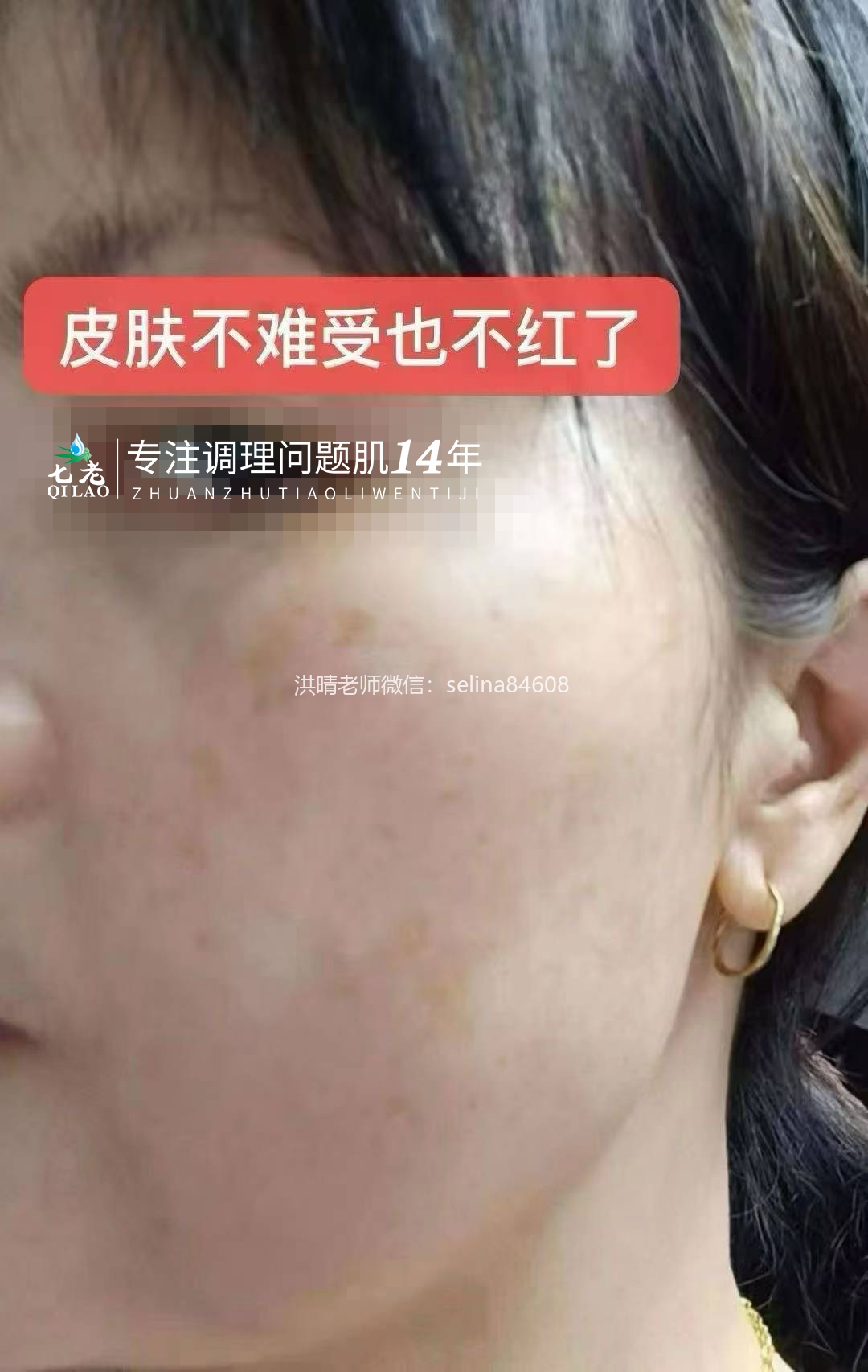 七老红烫肌发红发烫大红脸修护记录