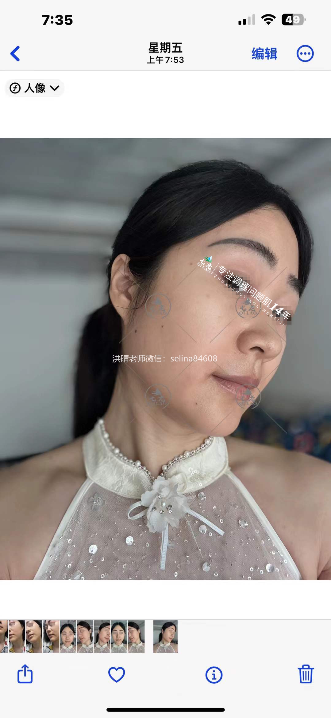 七老反复过敏修护案例