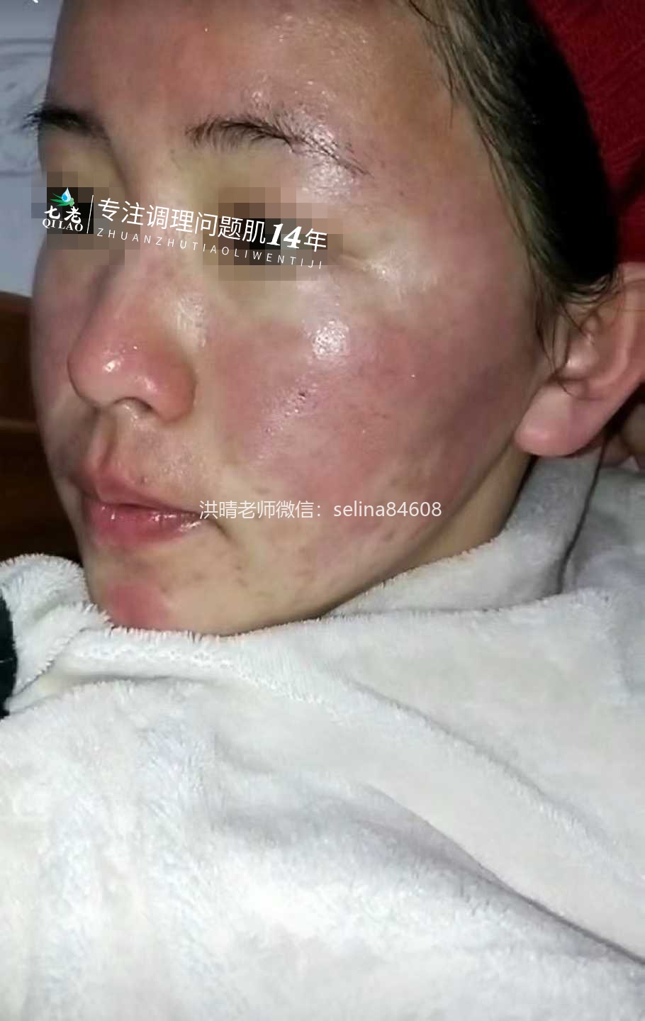 七老激素脸玫瑰脸修护案例