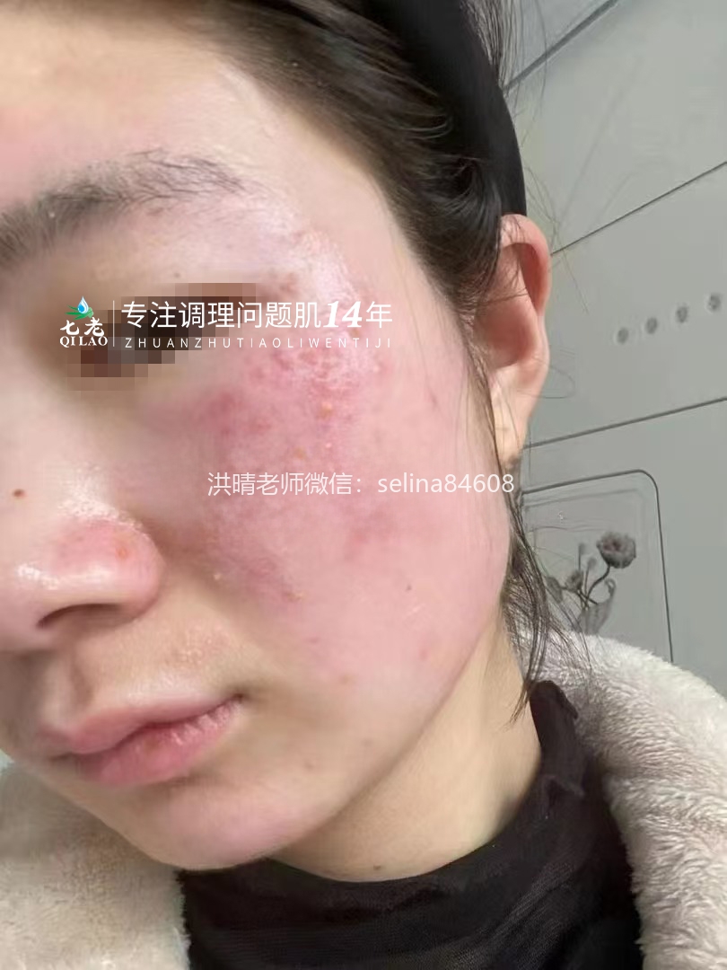 七老激素脸修复案例