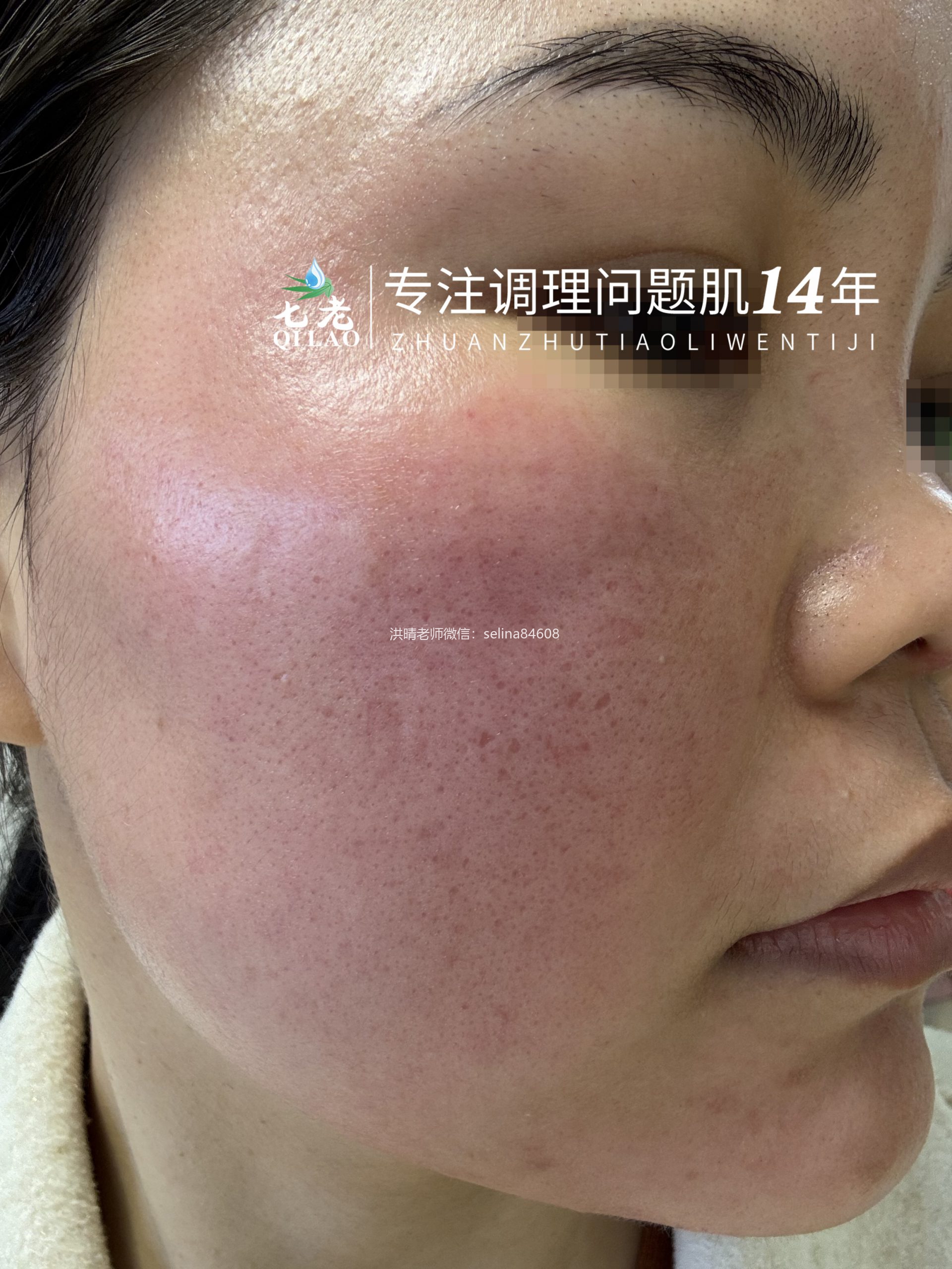 七老发红发烫大红脸红黑脸修护案例