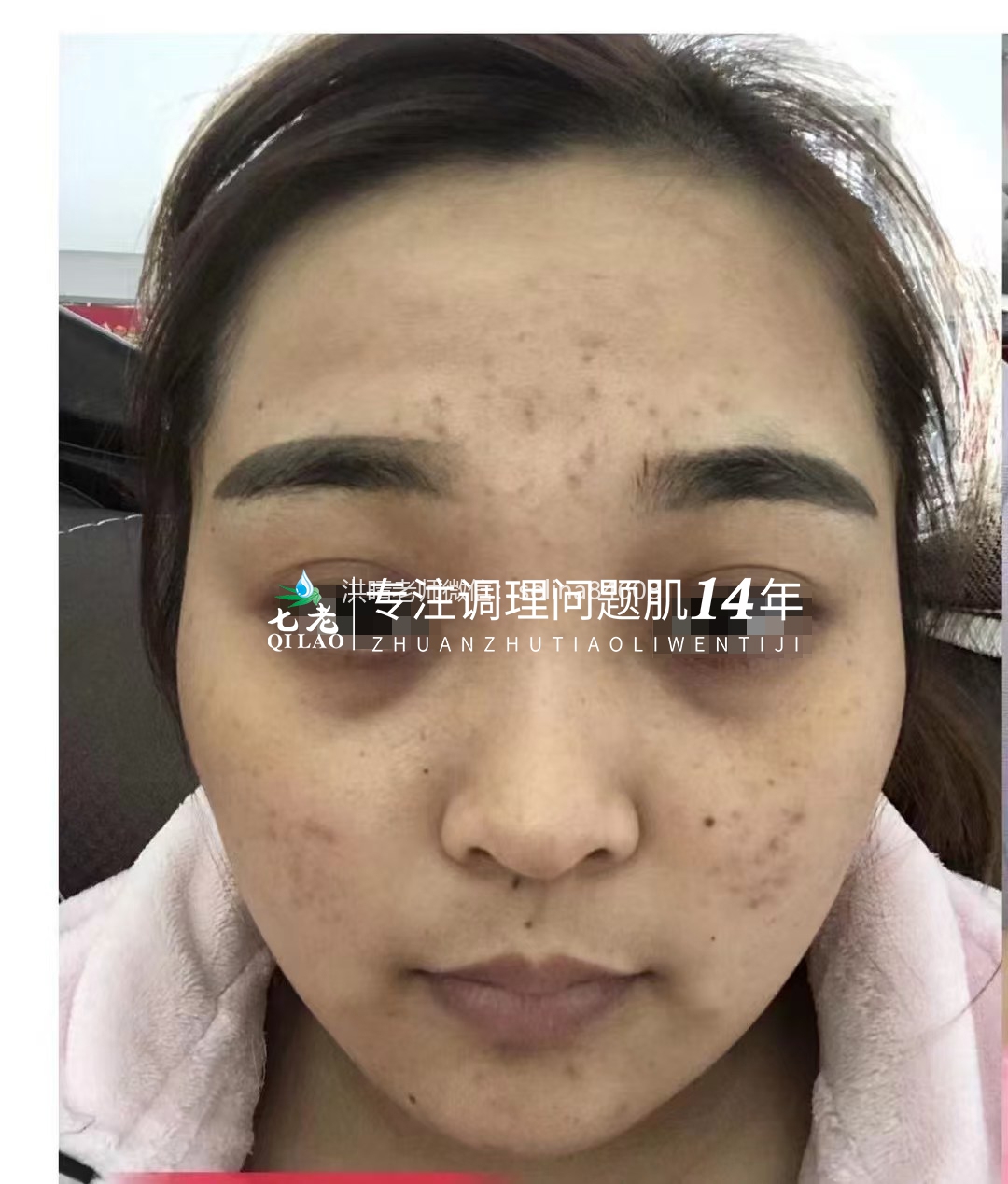 七老屏障受损反复敏感长痘修护案例