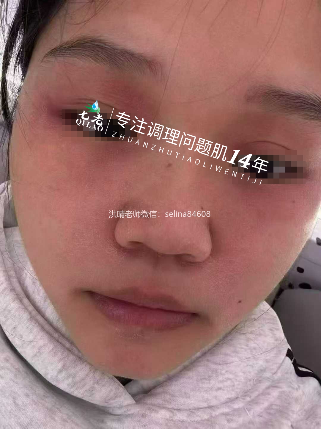 七老脂溢性皮炎修护传明酸反馈