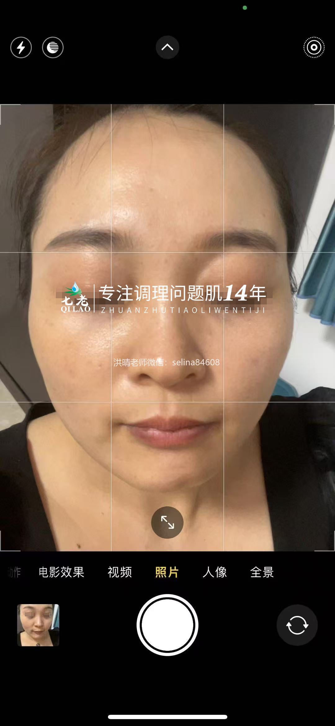 七老屏障受损反复敏感长痘修护案例