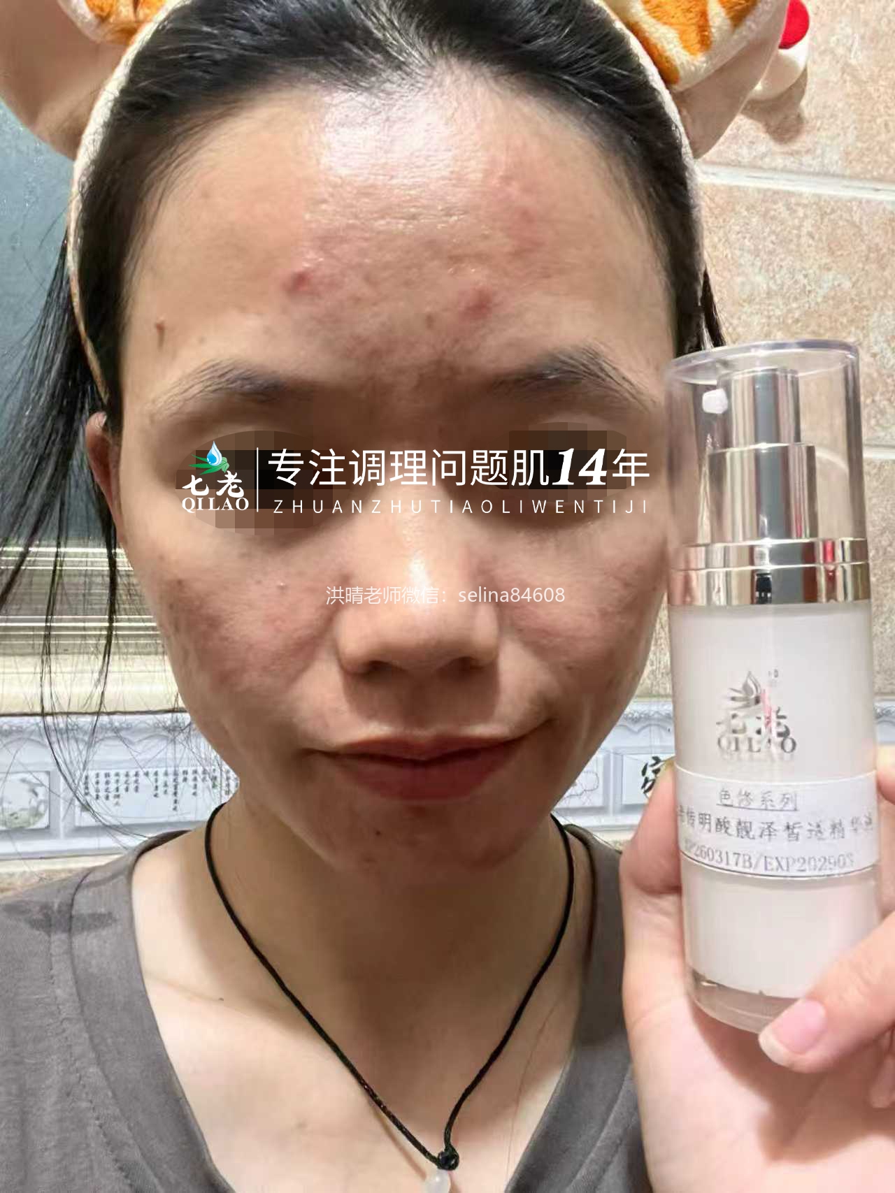 七老红肿脓包顽固痘痘肌修护案例