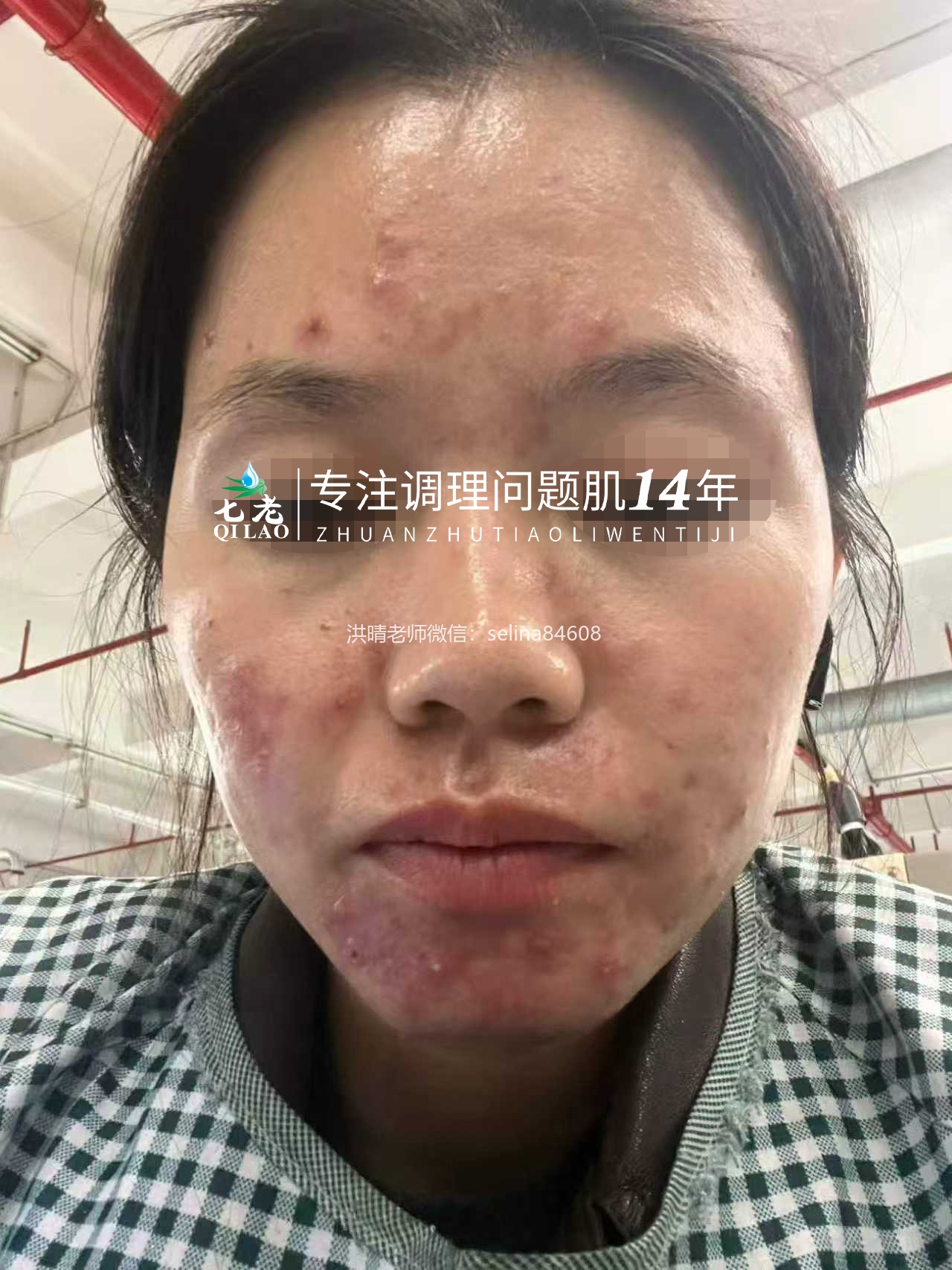 七老红肿脓包顽固痘痘肌修护案例