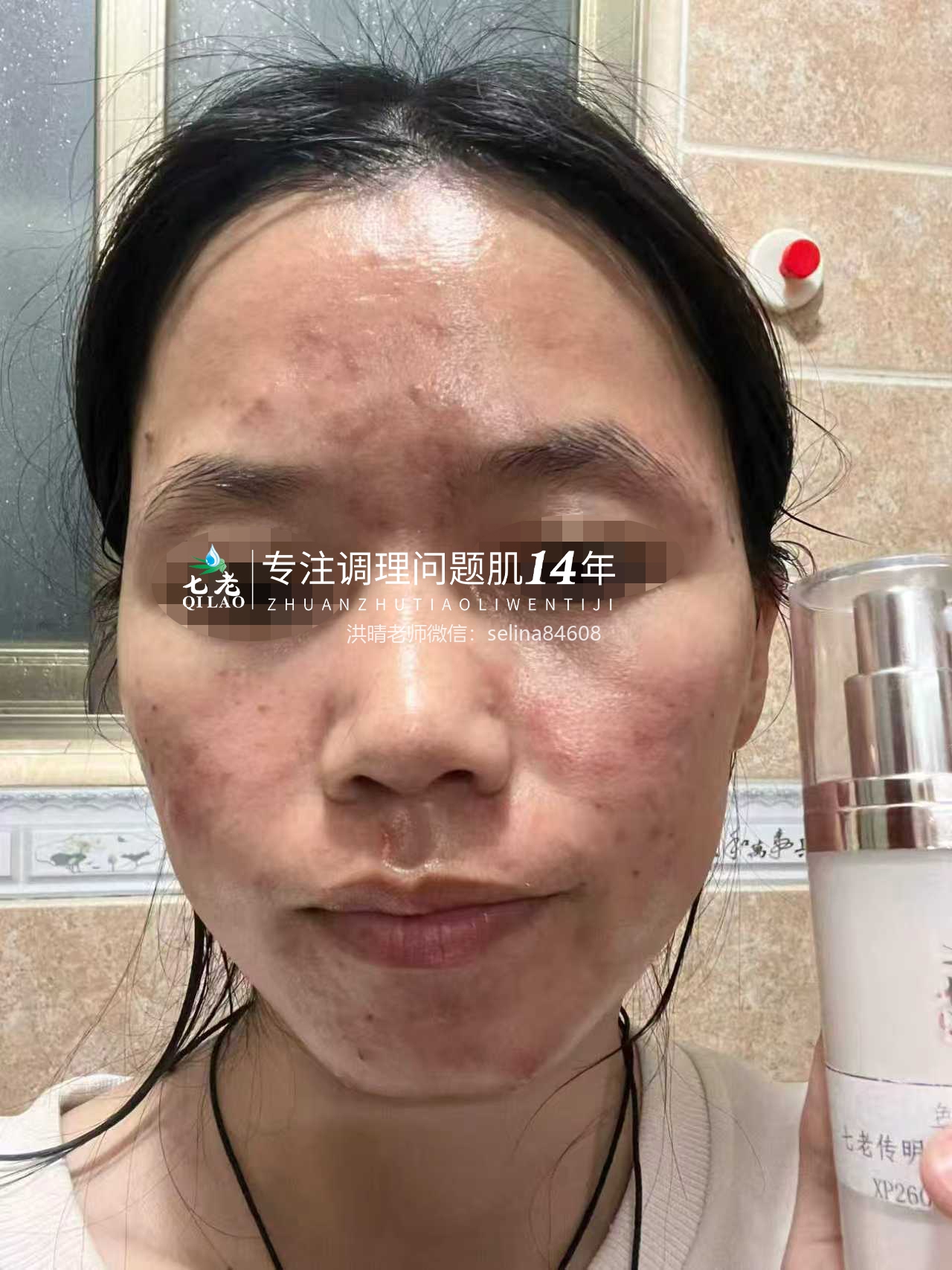 七老红肿脓包顽固痘痘肌修护案例