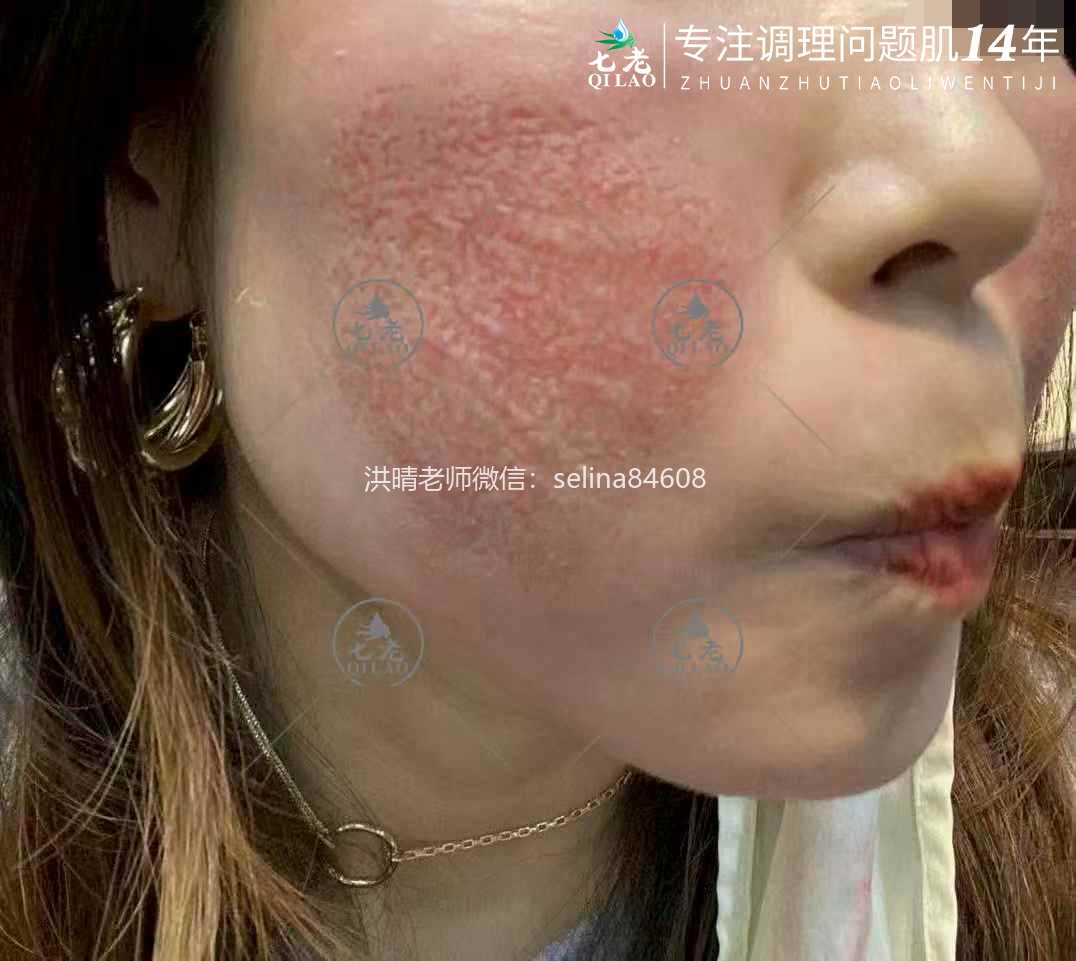 七老激素脸修护案例