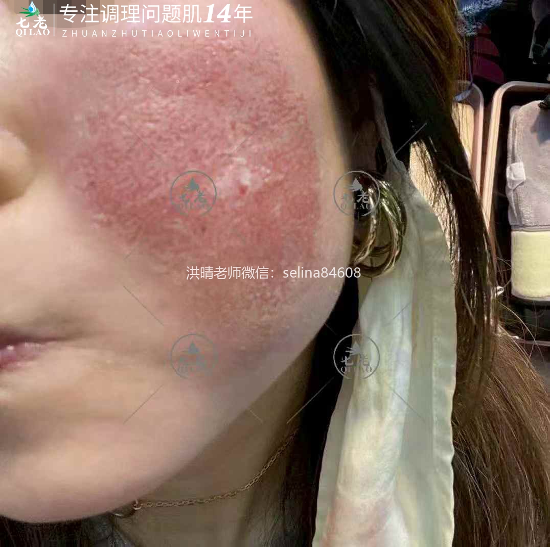 七老激素脸修护案例