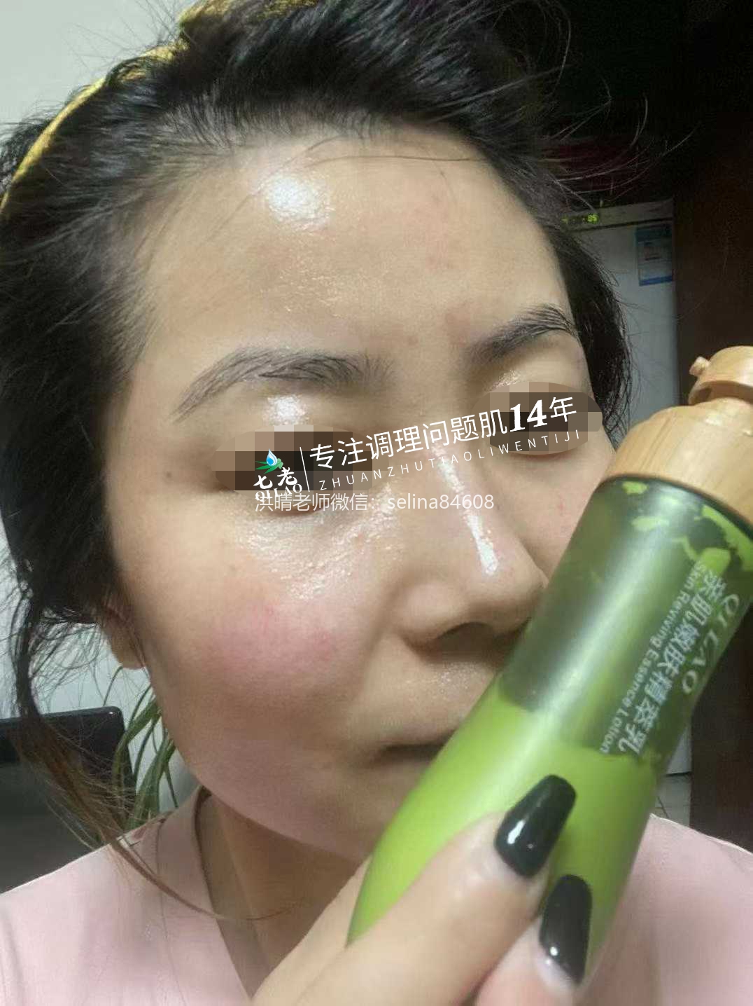 七老激素脸修护案例