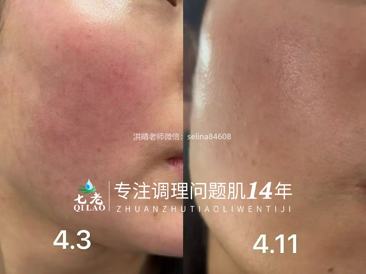 七老传明酸→红黑脸，反复红烫胀，疹子暗沉暗黄色沉的福音