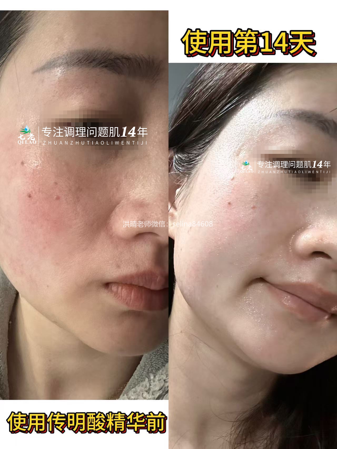 七老传明酸精华14天变化对比效果反馈