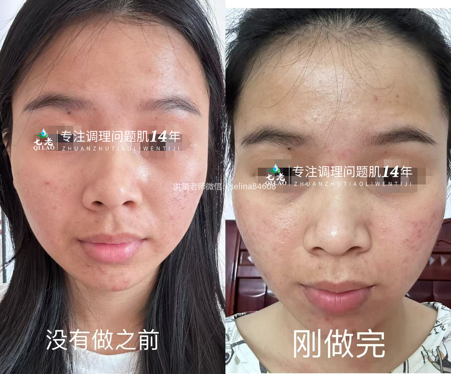 七老胶原水光做一次的前后对比