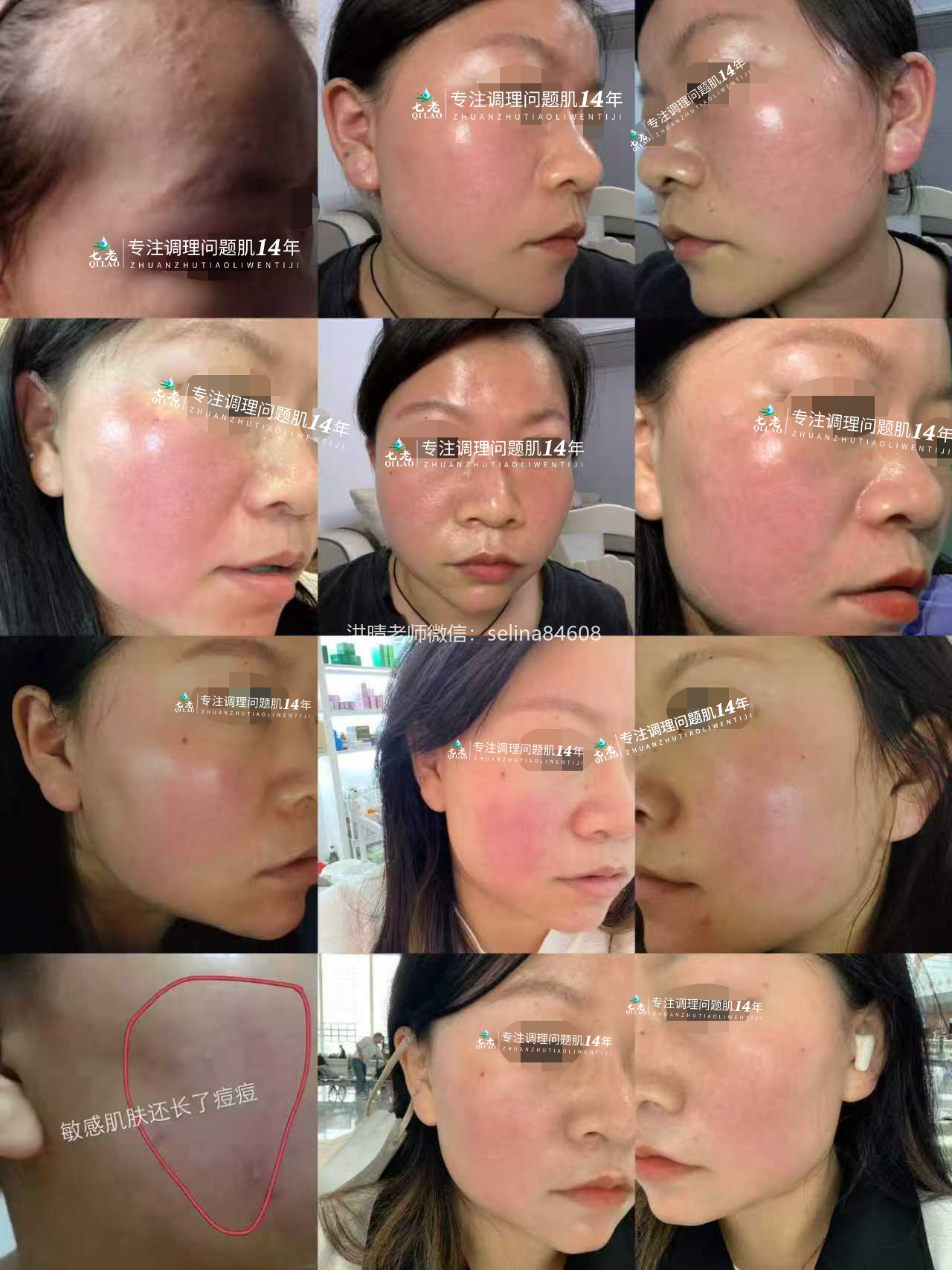 七老红烫肌大红脸，发红发烫修护案例