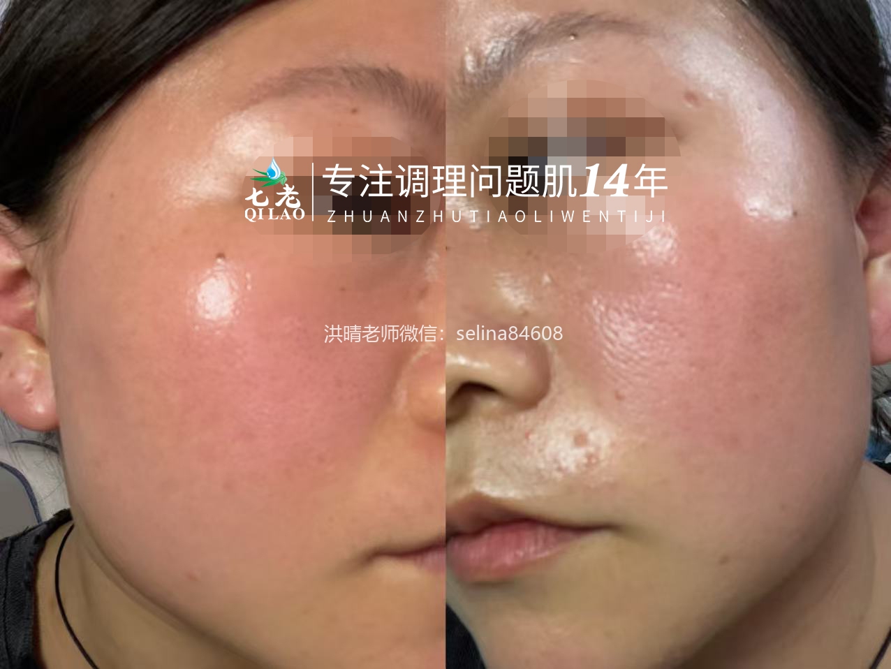 七老红烫肌大红脸，发红发烫修护案例