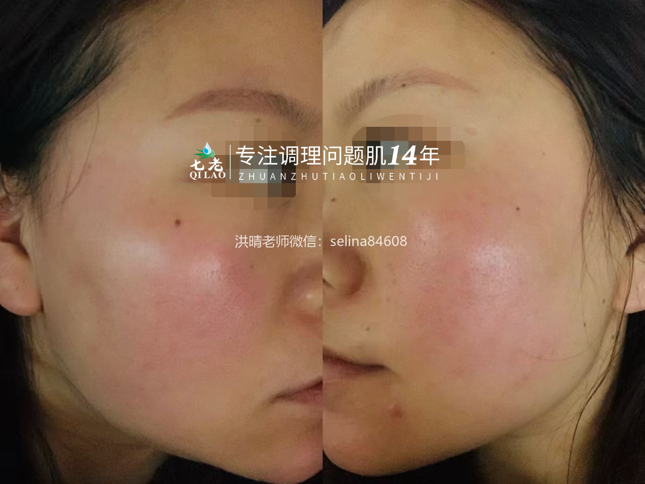 七老红烫肌大红脸，发红发烫修护案例