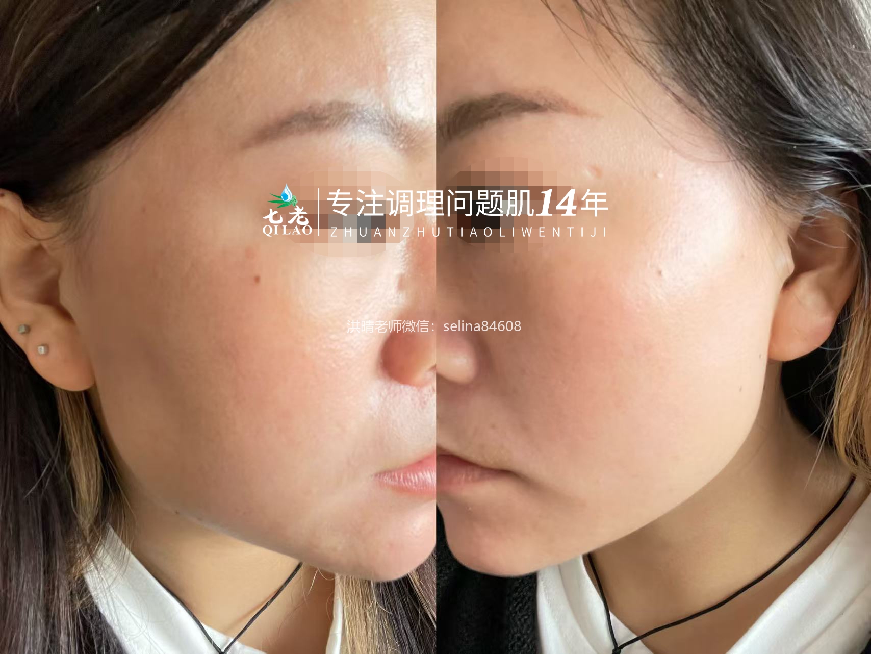 七老红烫肌大红脸，发红发烫修护案例