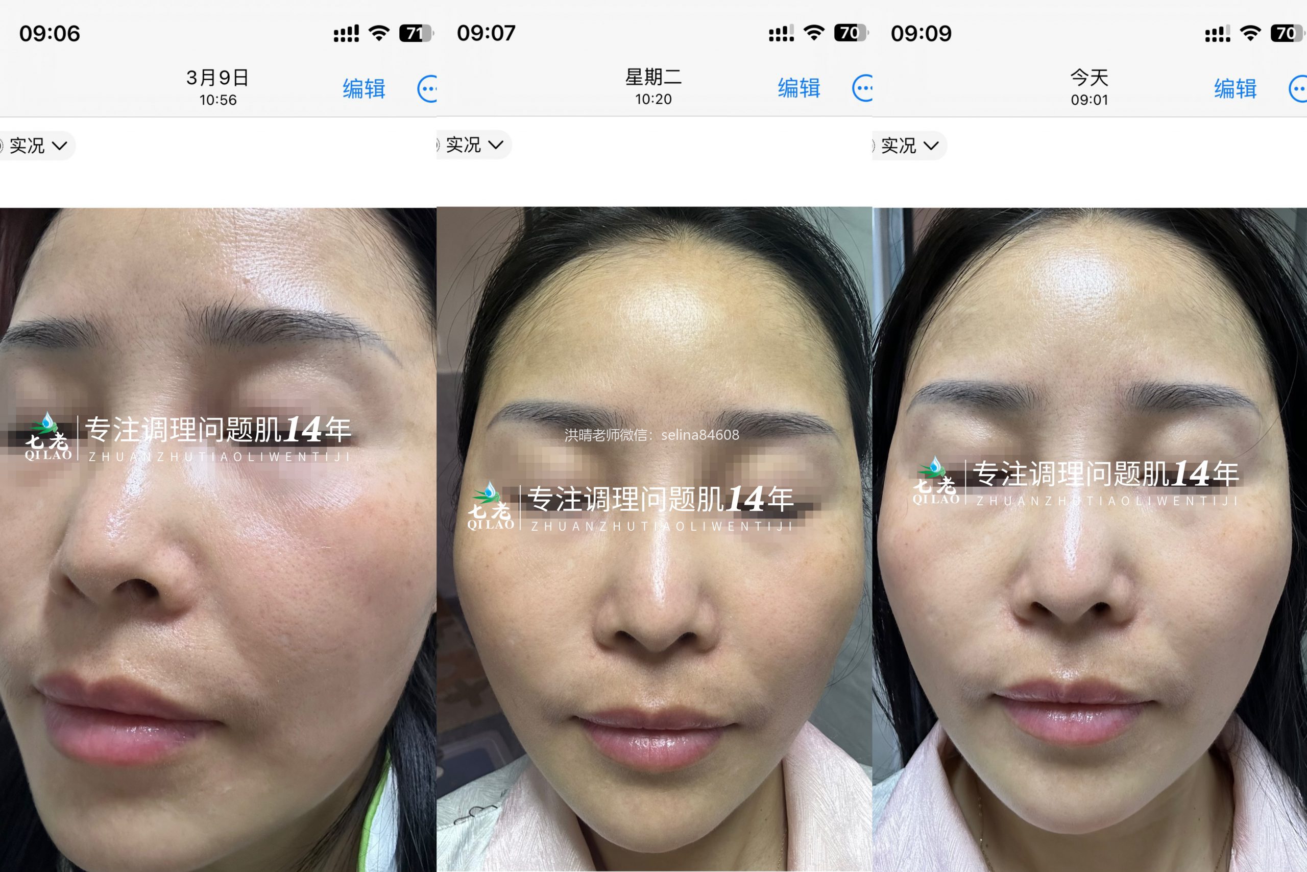 七老黑红脸用传明酸9天的对比变化效果