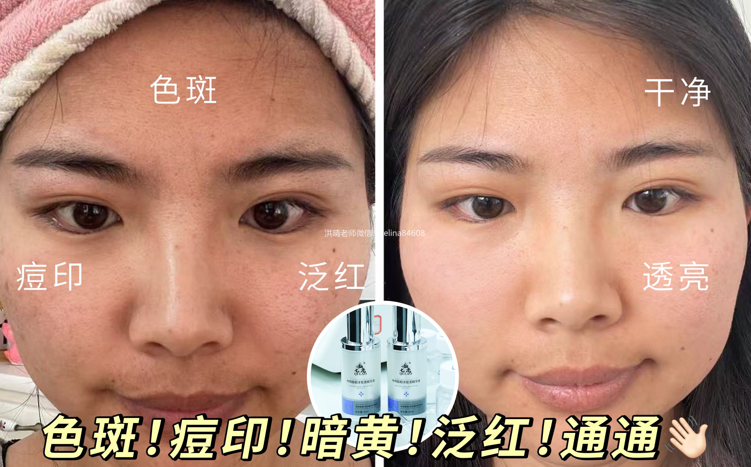 七老传明酸→色沉，斑斑，暗黄暗沉，红黑脸，黑红脸用起来