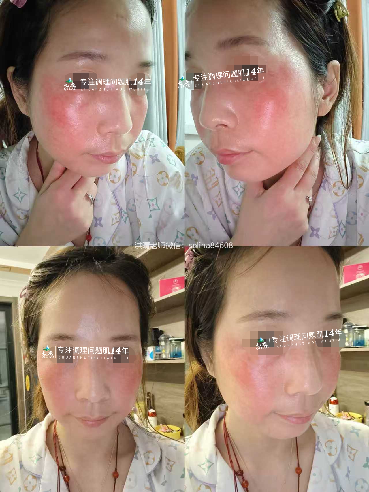 七老屏障受损敏感肌角质层薄修护案例