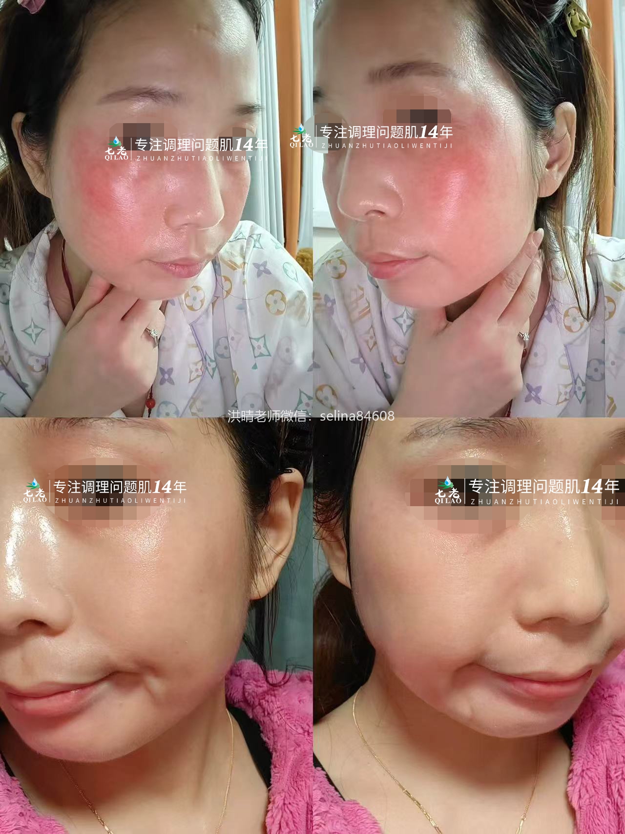 七老屏障受损敏感肌角质层薄修护案例