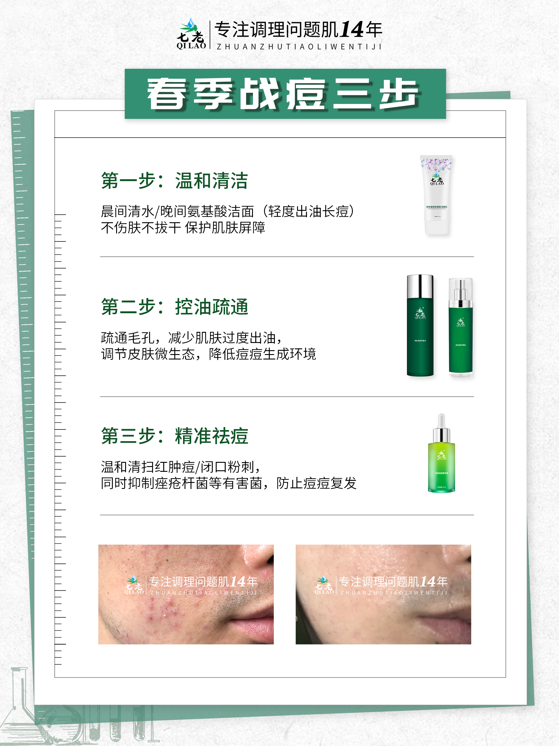 春季烂脸祛痘指南