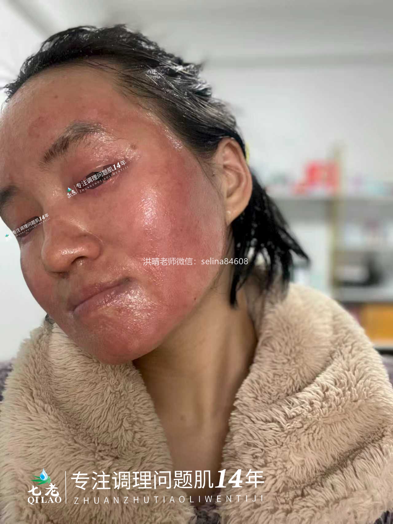 七老反复过敏性爆发性皮炎修护案例