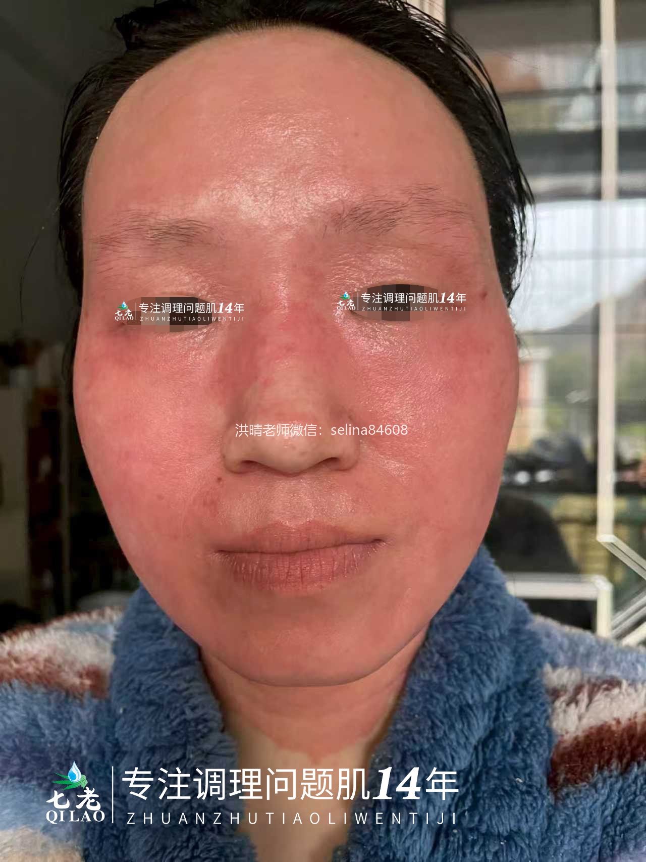 七老反复过敏性爆发性皮炎修护案例