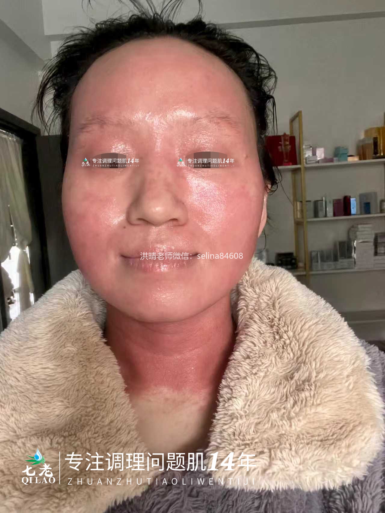 七老反复过敏性爆发性皮炎修护案例