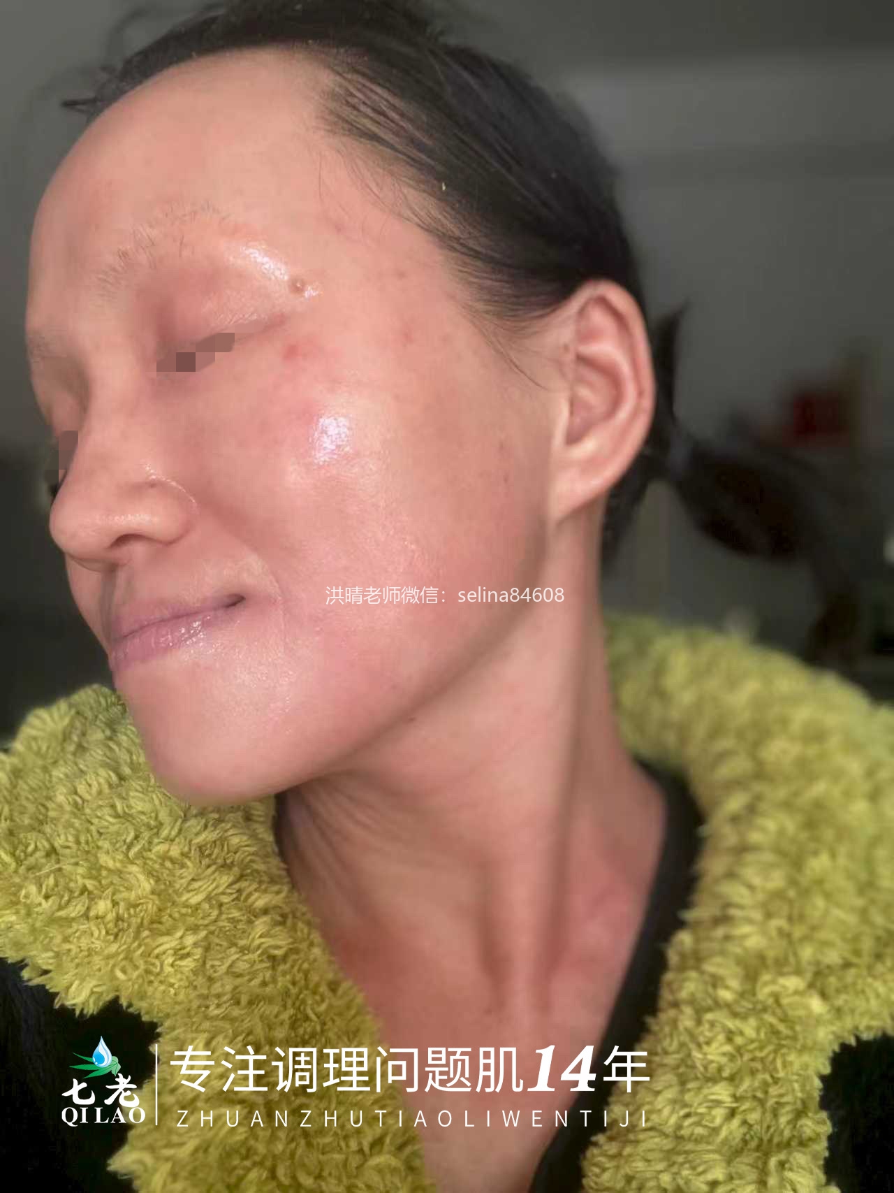 七老反复过敏性爆发性皮炎修护案例