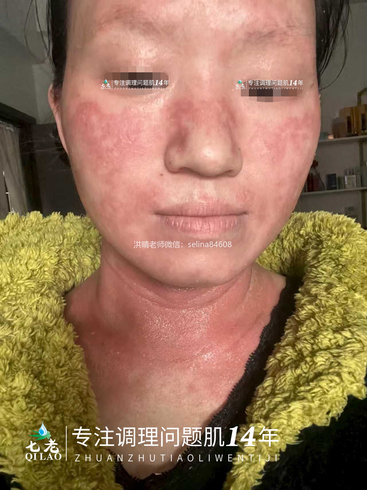 七老反复过敏性爆发性皮炎修护案例