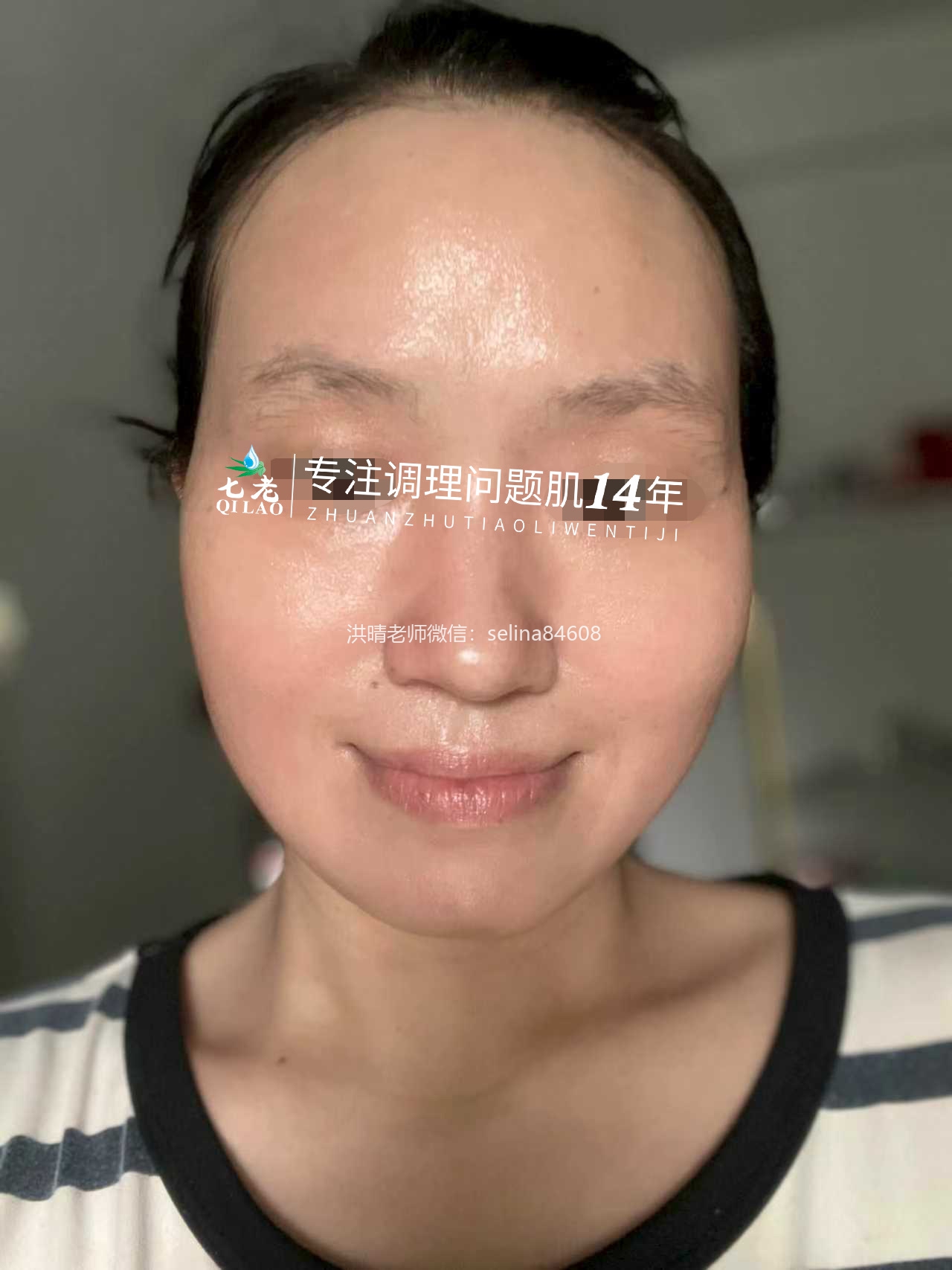 七老反复过敏性爆发性皮炎修护案例