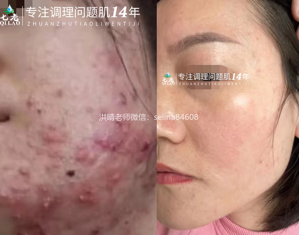 七老严重痘痘肌修护案例