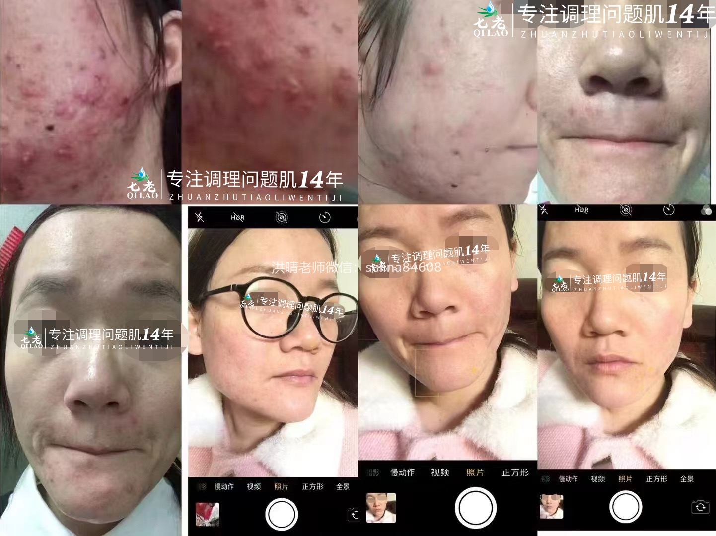 七老严重痘痘肌修护案例