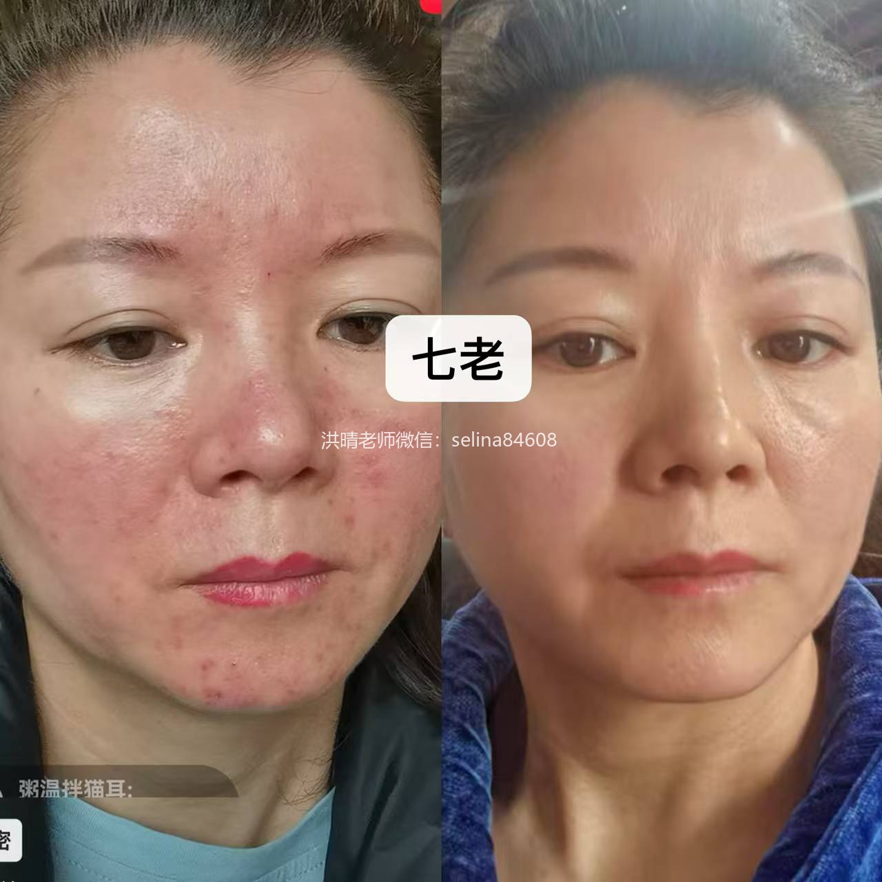 七老玫瑰痤疮修护案例