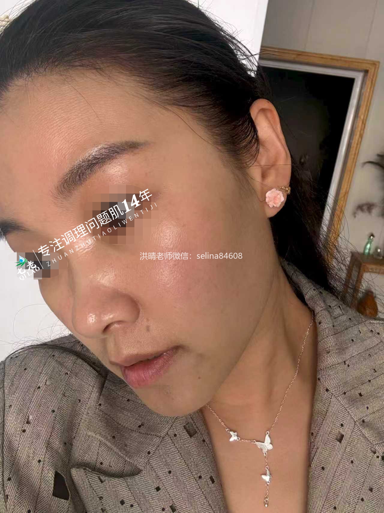 七老激素脸红肿烫痒疹子疙瘩渗液结痂修护案例