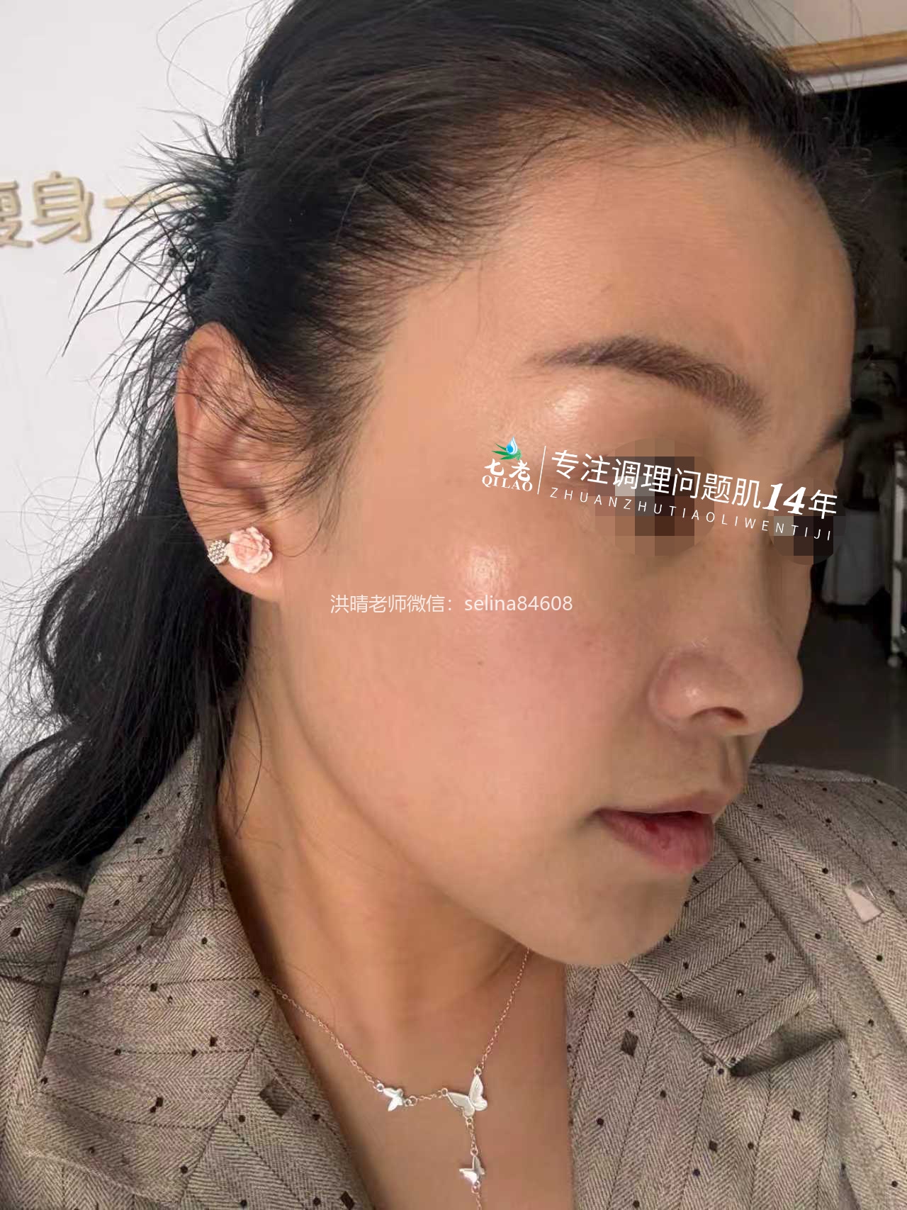 七老激素脸红肿烫痒疹子疙瘩渗液结痂修护案例